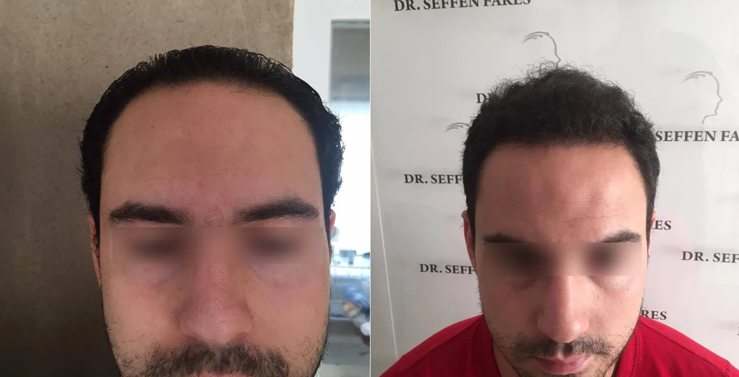 Patient 23, before and after hair transplant, view 1