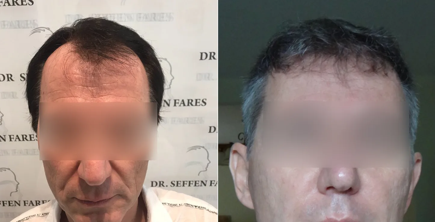 Patient 24, avant et après greffe de cheveux, vue 1