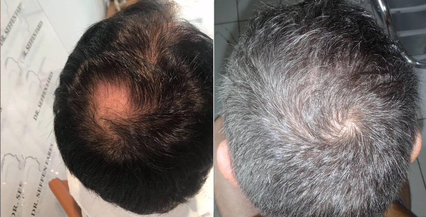 Patient 24, avant et après greffe de cheveux, vue 2