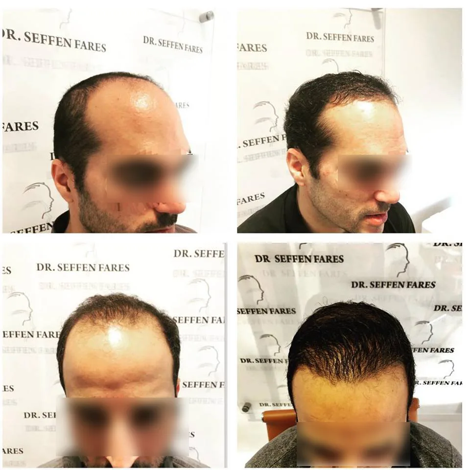 Patient 9, before and after hair transplant, view 3