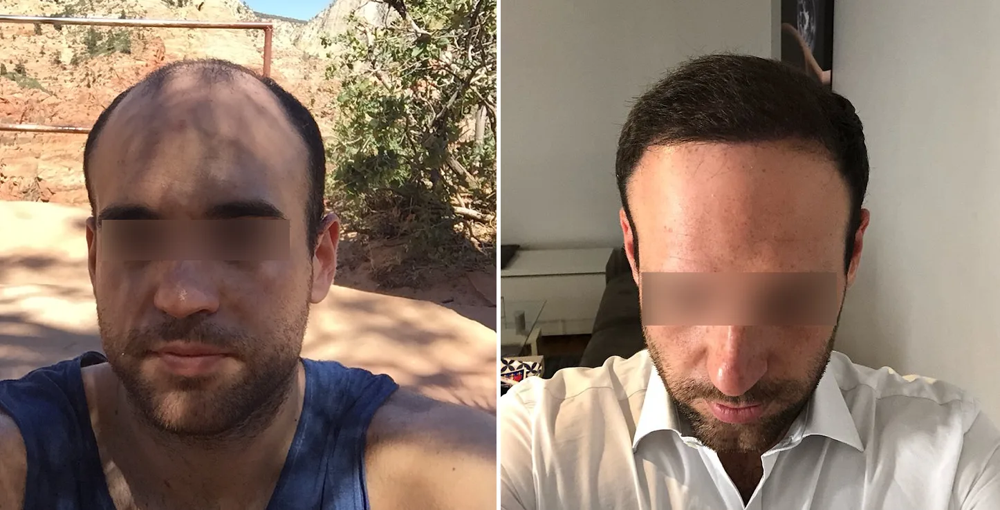 Patient 11, before and after hair transplant, view 1