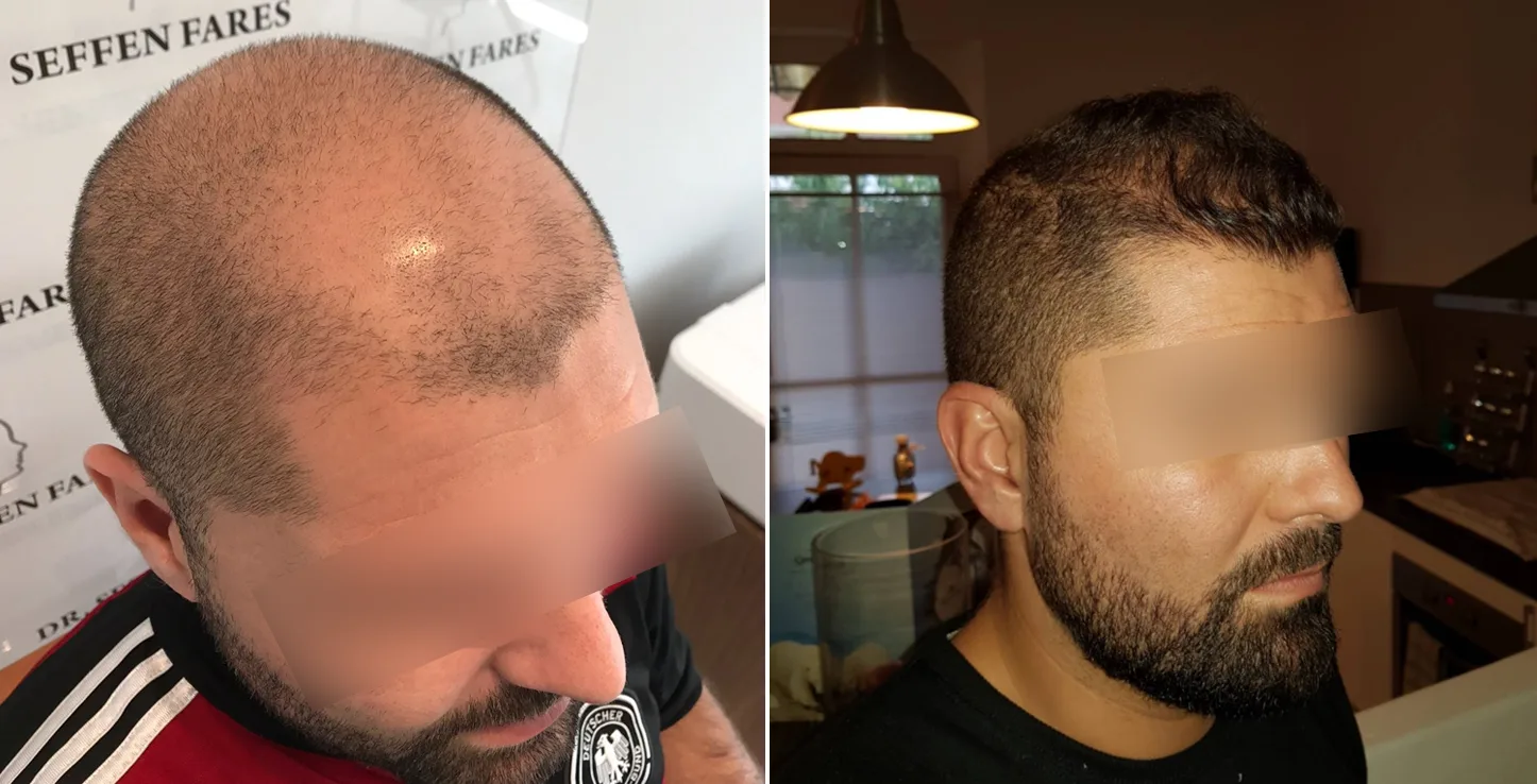 Patient 12, before and after hair transplant, view 2