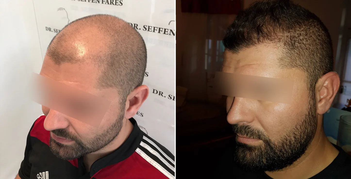 Patient 12, before and after hair transplant, view 3