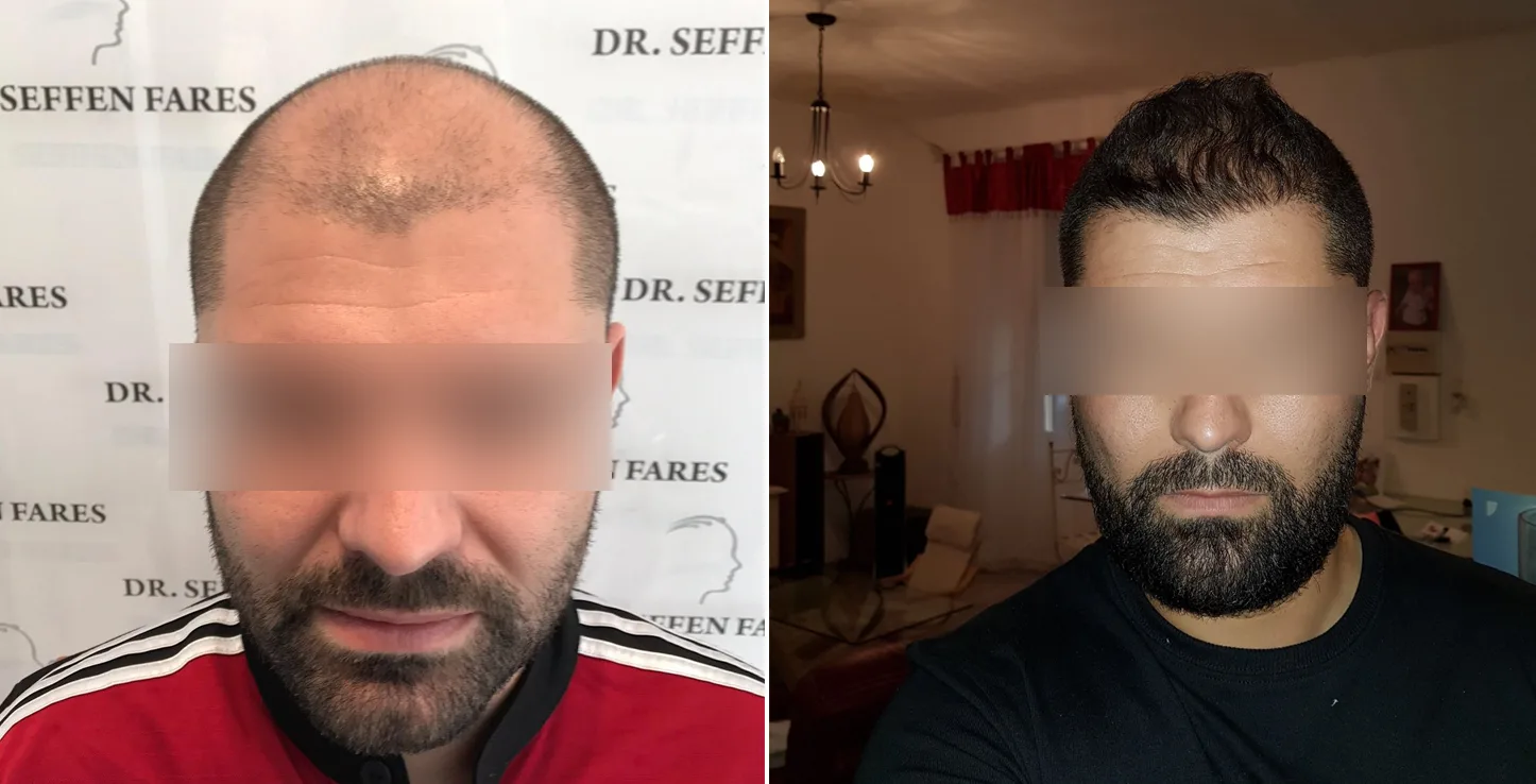 Patient 12, before and after hair transplant, view 1