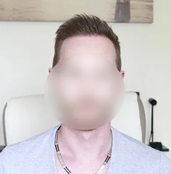 Patient 6, après greffe de cheveux