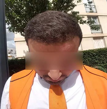 Patient 15, après greffe de cheveux