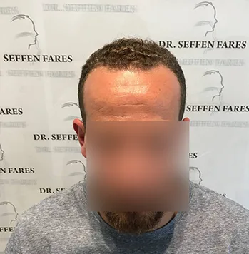 Patient 16, après greffe de cheveux