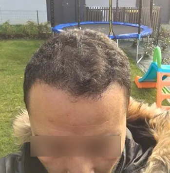 Patient 18, après greffe de cheveux
