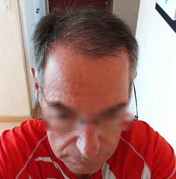 Patient 19, après greffe de cheveux