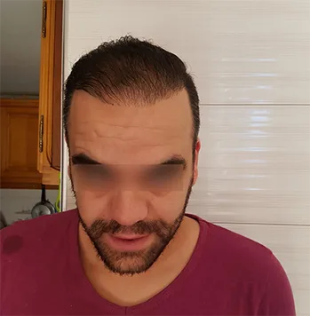 Patient 21, après greffe de cheveux