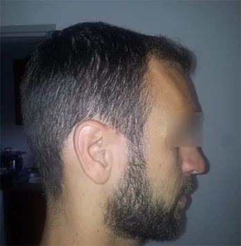 Patient 22, après greffe de cheveux