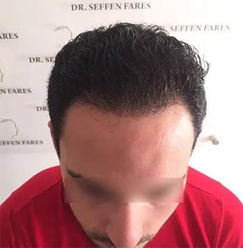 Patient 23, après greffe de cheveux