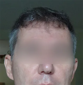 Patient 24, après greffe de cheveux