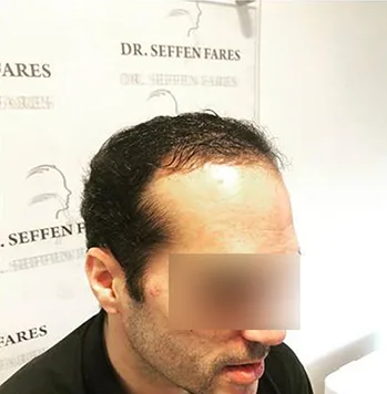 Patient 7, après greffe de cheveux