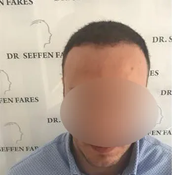 Patient 10, après greffe de cheveux