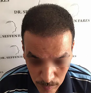 Patient 17, après greffe de cheveux