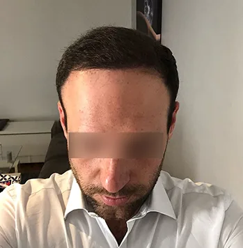 Patient 11, après greffe de cheveux