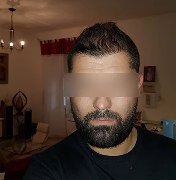 Patient 12, après greffe de cheveux