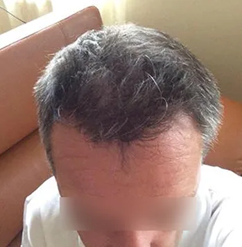 Patient 13, après greffe de cheveux
