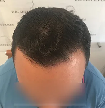 Patient 14, après greffe de cheveux