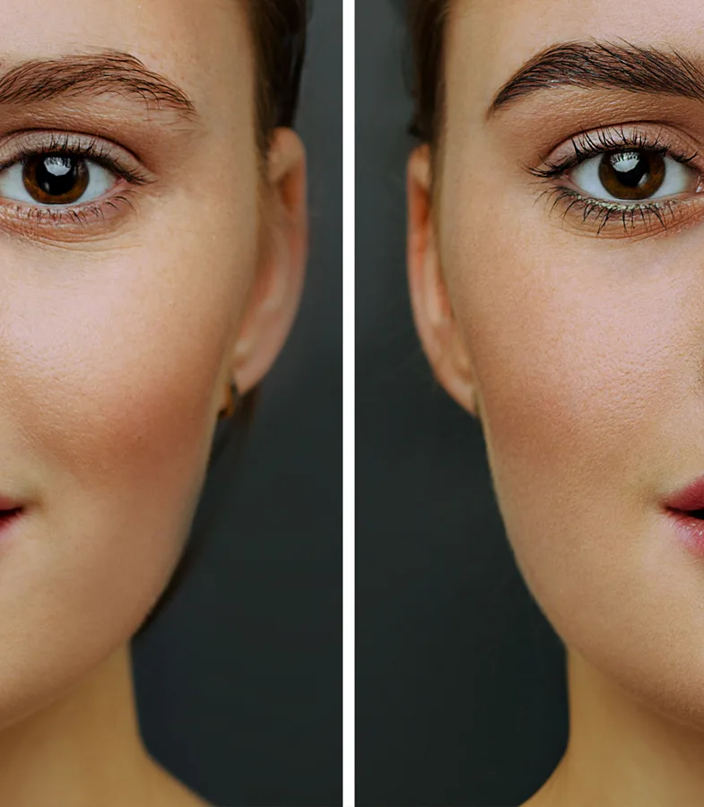 Avant / après une greffe de sourcils