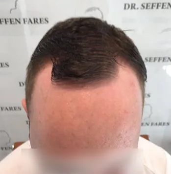 Patient 6, avant greffe de cheveux