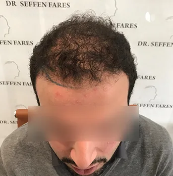 Patient 15, avant greffe de cheveux