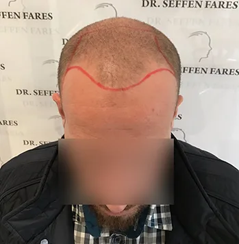 Patient 16, avant greffe de cheveux