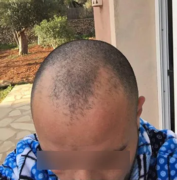 Patient 18, avant greffe de cheveux