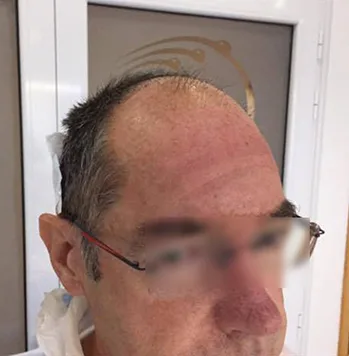Patient 19, avant greffe de cheveux