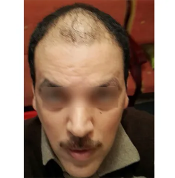 Patient 17, avant greffe de cheveux