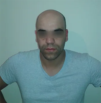 Patient 21, avant greffe de cheveux