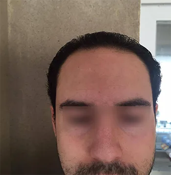 Patient 23, avant greffe de cheveux