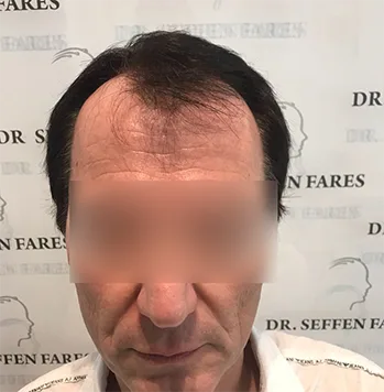 Patient 24, avant greffe de cheveux