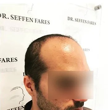 Patient 7, avant greffe de cheveux