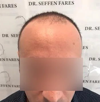 Patient 10, avant greffe de cheveux