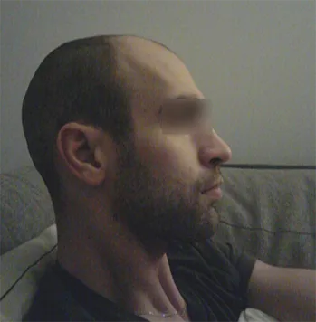 Patient 22, avant greffe de cheveux