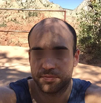 Patient 11, avant greffe de cheveux