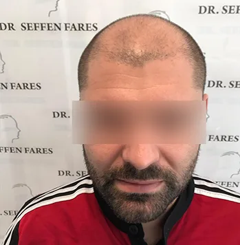 Patient 12, avant greffe de cheveux