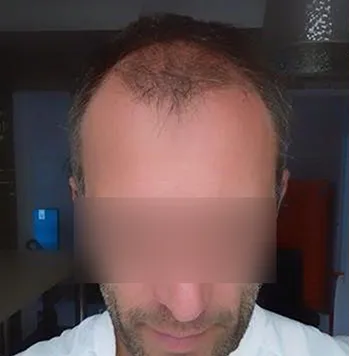 Patient 13, avant greffe de cheveux