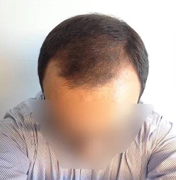 Patient 14, avant greffe de cheveux