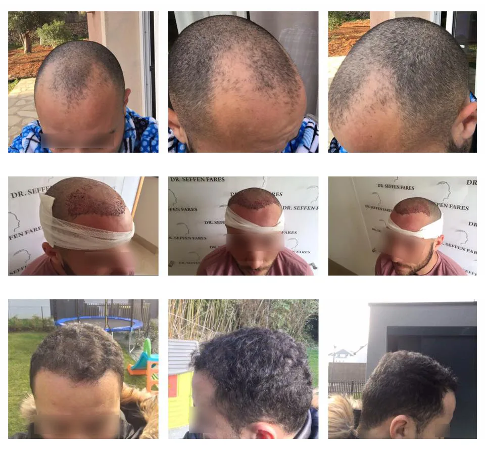 Patient 18, before and after hair transplant, view 1