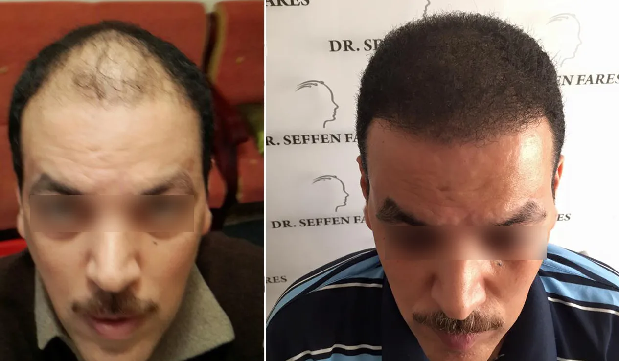 Patient 20, before and after hair transplant, view 1