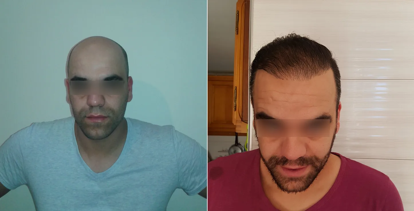 Patient 21, before and after hair transplant, view 1