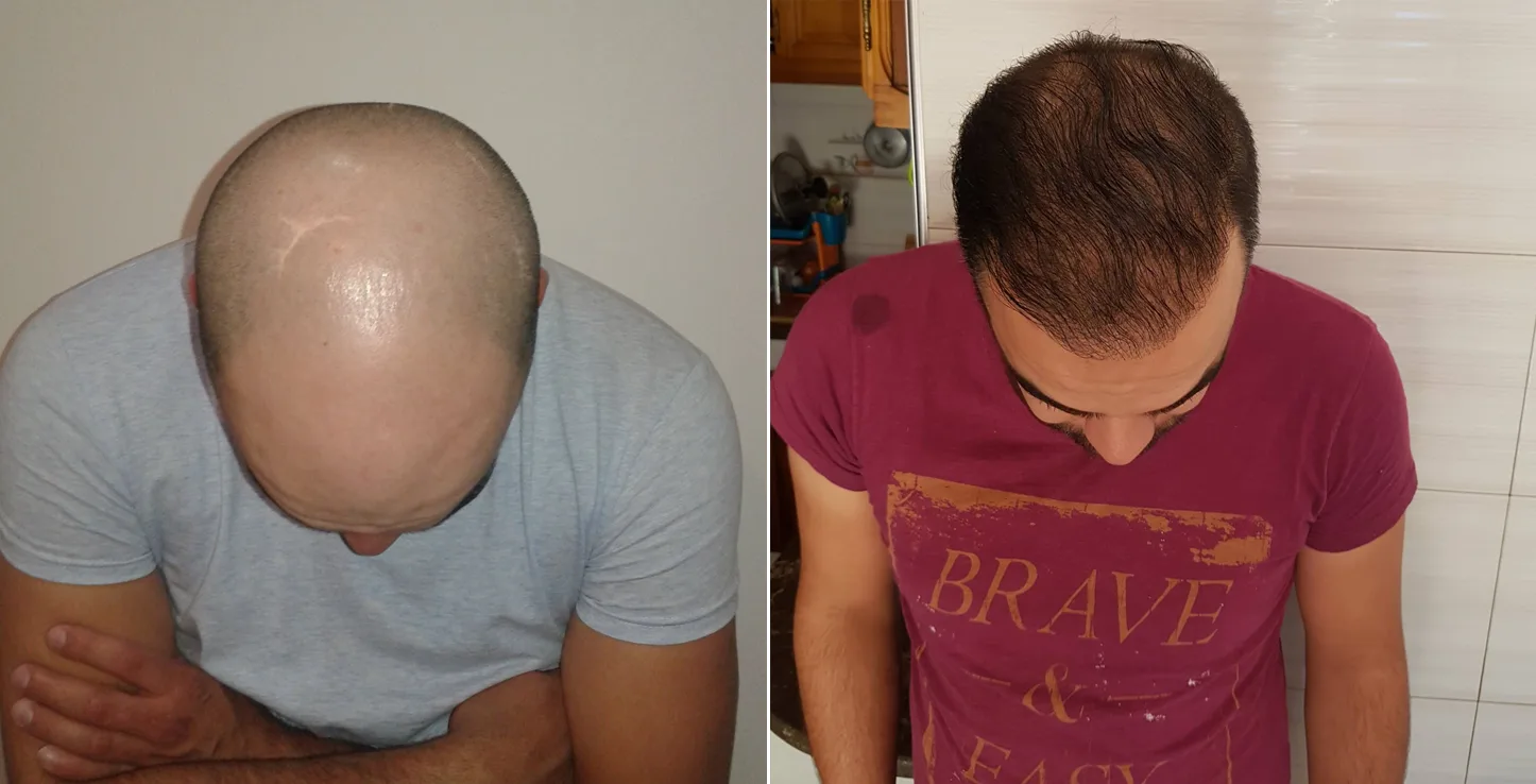 Patient 21, before and after hair transplant, view 2