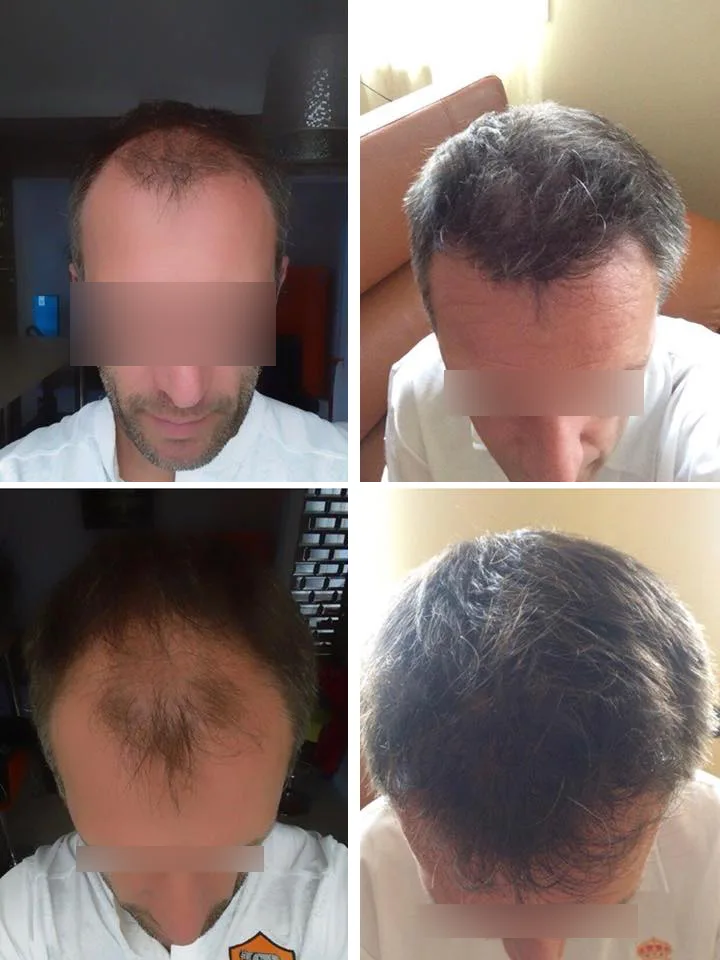 Patient 13, before and after hair transplant, view 1