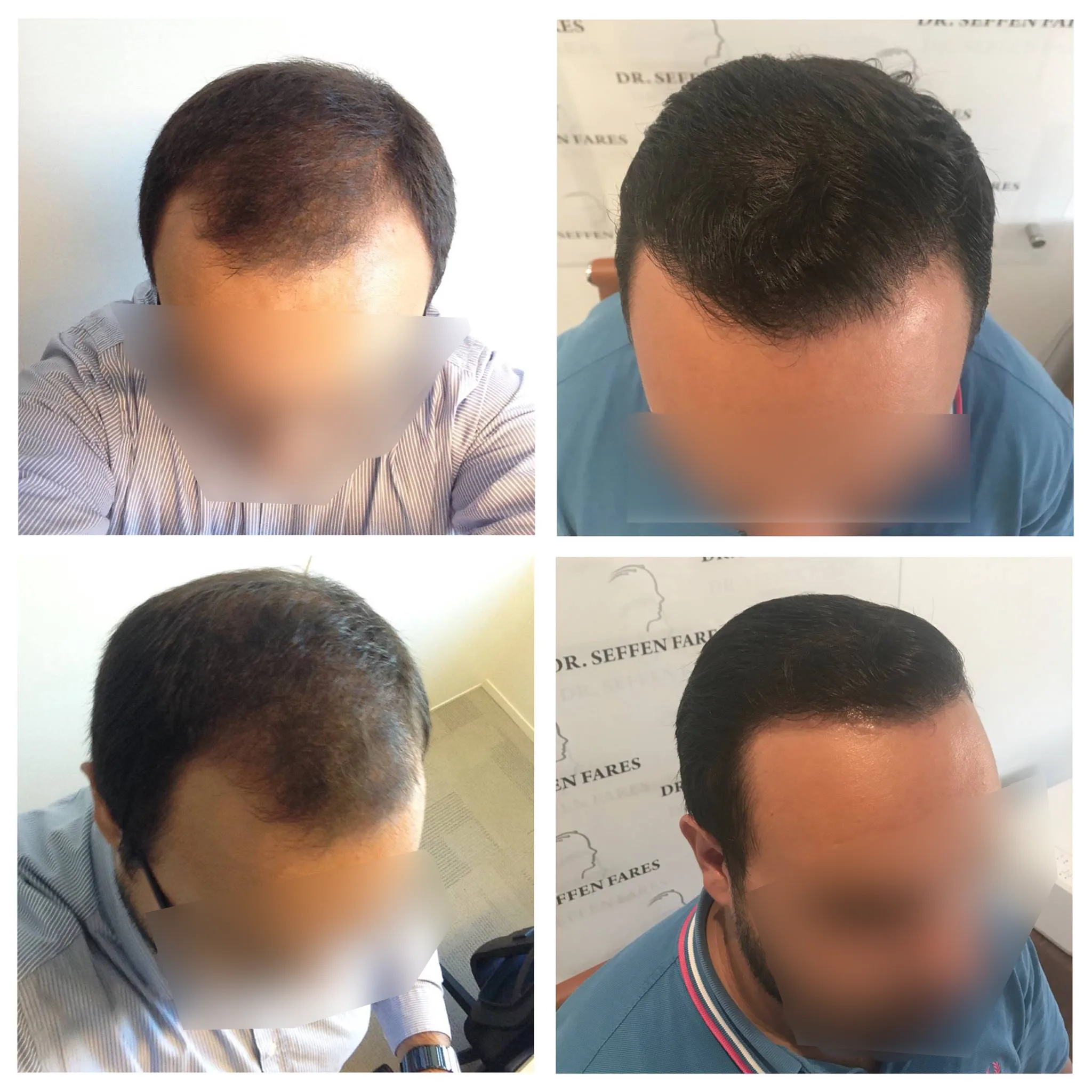 Patient 14, before and after hair transplant, view 1