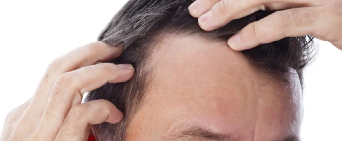 Post-operative hair loss