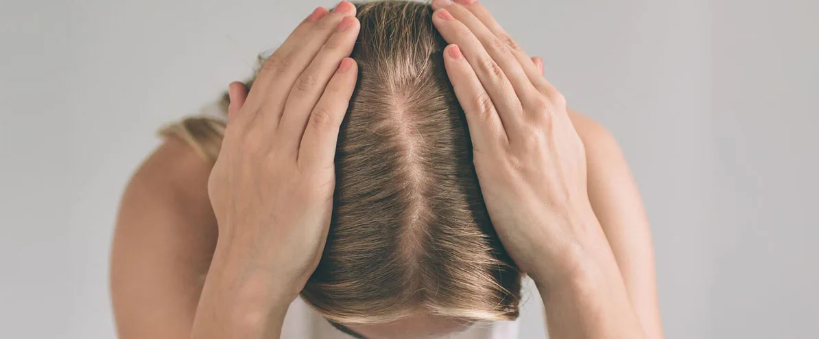 alopecie femme