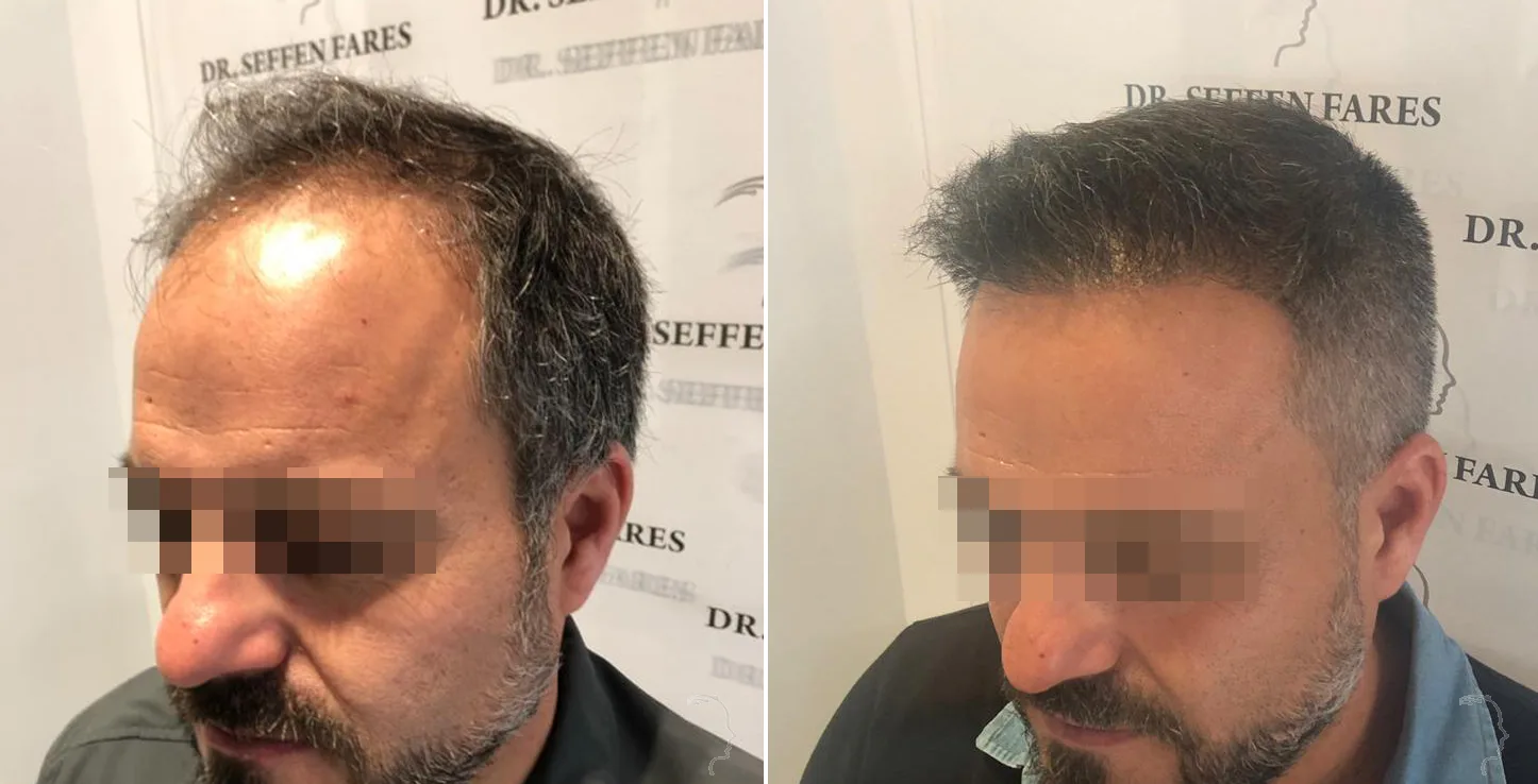 Patient 26, before and after hair transplant, view 1